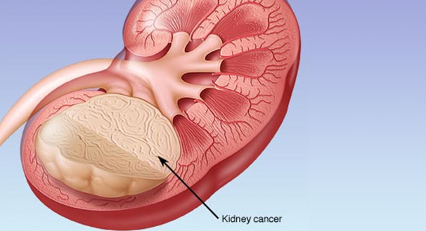 Καρκίνος νεφρού