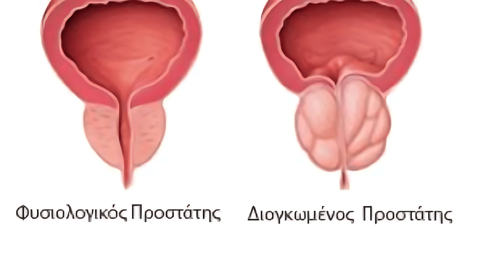 Απεικόνιση στυτικής δυσλειτουργίας – ανατομική προβολή πέους με μη επαρκή αιμάτωση κατά τη στύση.
